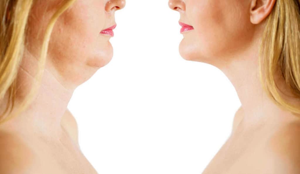Double Chin treatment Hook before and after results