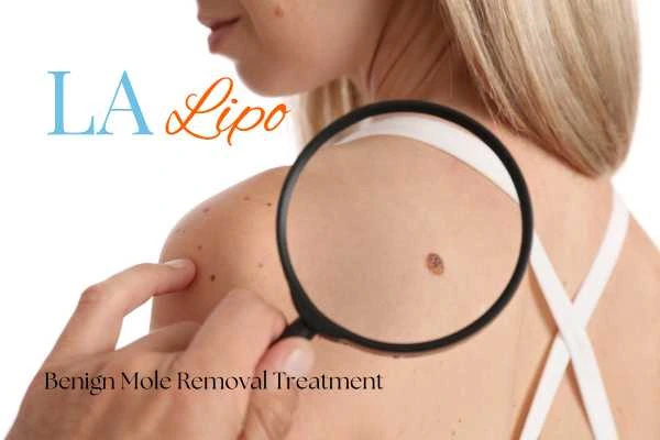 Woman having her inspection of blemish before mole removal Hook