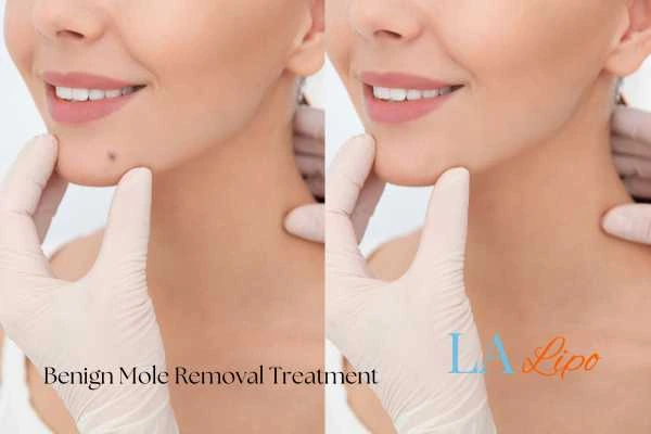Before and after mole removal Hook treatment