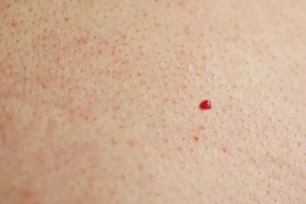 close up of a cherry angioma Hook
