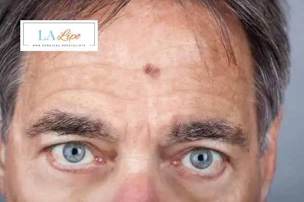 Solar Lentigo Removal Hook image of man with mark on his forehead