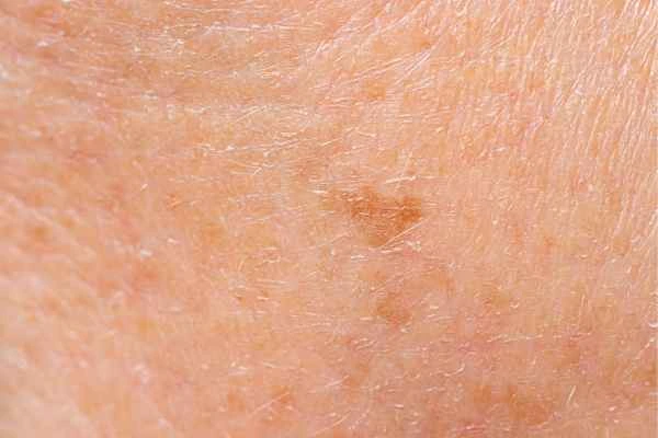 close up picture of age spots Hook
